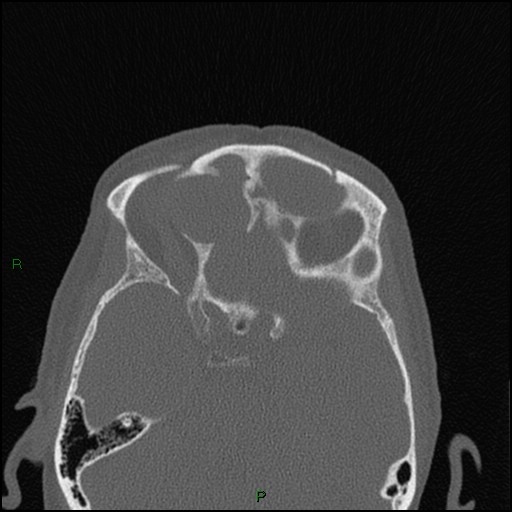 Bilateral frontal mucoceles (Radiopaedia 82352-96454 Axial bone window 118).jpg