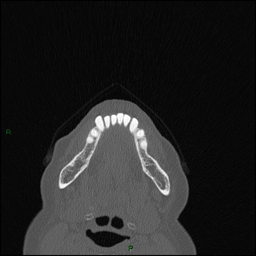 Bilateral frontal mucoceles (Radiopaedia 82352-96454 Axial bone window 314).jpg