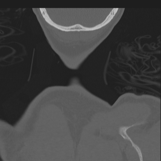 Bilateral locked facets (Radiopaedia 33850-35016 Coronal bone window 95).png