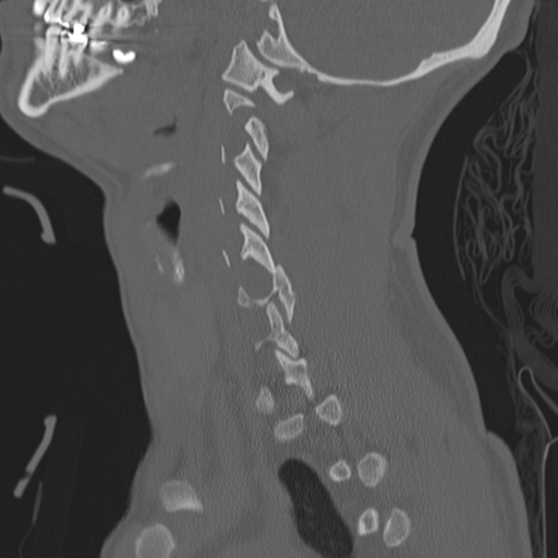 File:Bilateral locked facets (Radiopaedia 33850-35016 Sagittal bone window 9).png