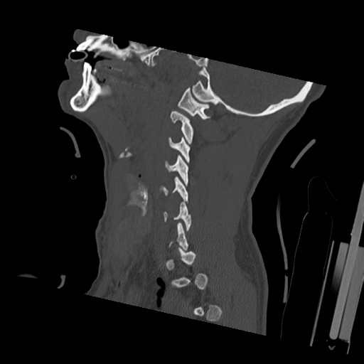 File:Bilateral locked facets (Radiopaedia 33850-35023 Sagittal bone window 44).png