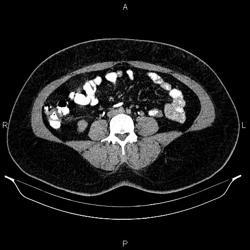Bilateral ovarian dermoid cysts (Radiopaedia 85785-101603 Axial C+ delayed 44).jpg