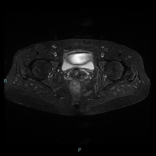 File:Bilateral ovarian fibroma (Radiopaedia 44568-48293 Axial STIR 21).jpg