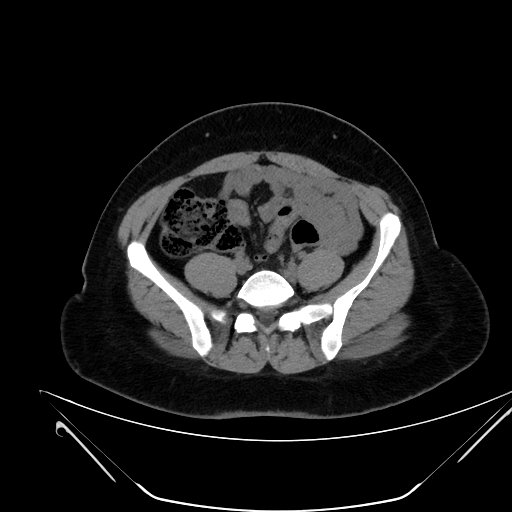 File:Bilateral ovarian mature cystic teratomas (Radiopaedia 79373-92457 Axial non-contrast 41).jpg