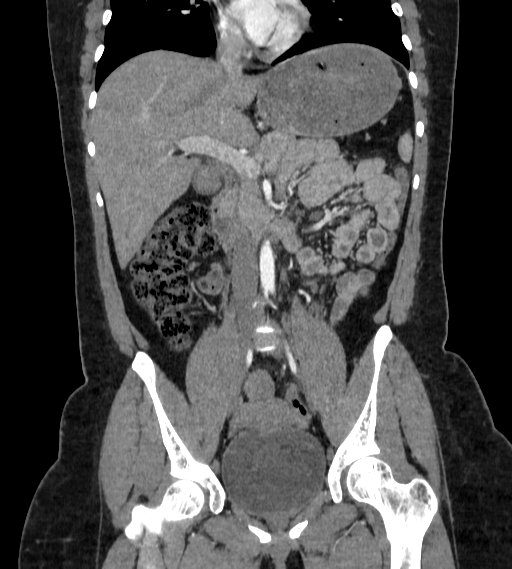 Bilateral ovarian mature cystic teratomas (Radiopaedia 79373-92457 B 30).jpg