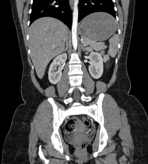 Bilateral ovarian mature cystic teratomas (Radiopaedia 79373-92457 B 54).jpg
