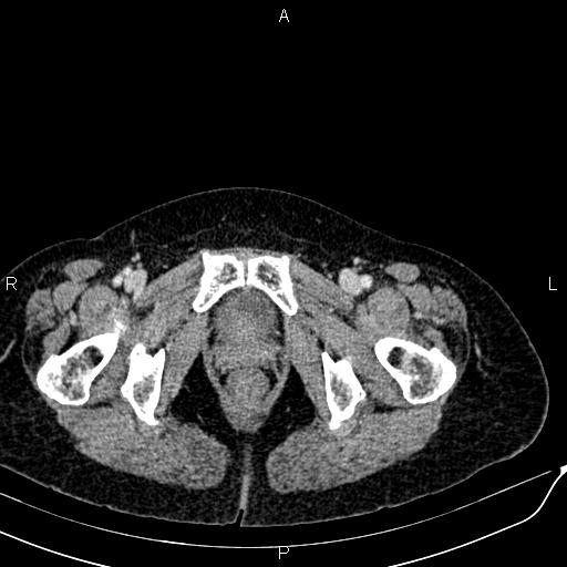 Bilateral ovarian serous cystadenocarcinoma (Radiopaedia 86062-101989 B 103).jpg