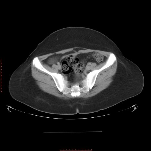 File:Bilateral ovarian serous cystadenocarcinoma with right ovarian torsion (Radiopaedia 32640-33611 A 34).jpg