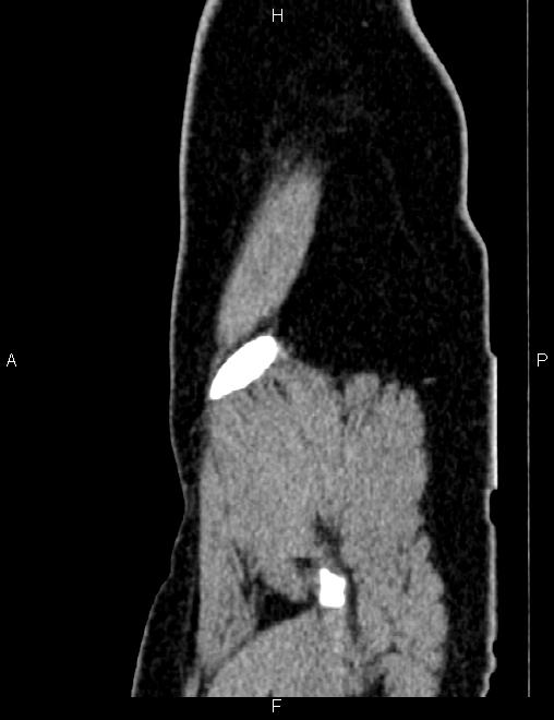 Bilateral ovarian teratoma (Radiopaedia 83131-97503 D 17).jpg