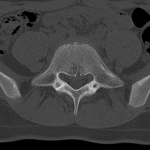 File:Bilateral pars defect (Radiopaedia 26691-26846 Axial bone window 55).jpg