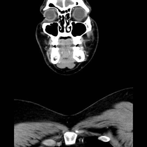 Bilateral peritonsillar abscess (Radiopaedia 85065-100610 Coronal 17).jpg