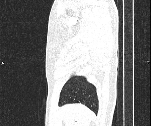 File:Bilateral pulmonary AVM (Radiopaedia 83134-97505 Sagittal lung window 19).jpg