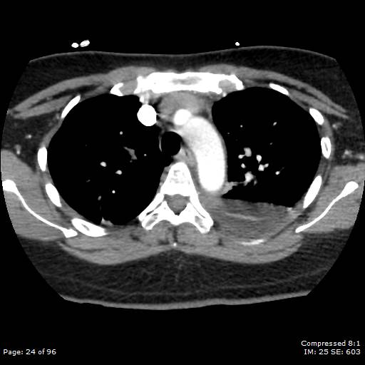 File:Bilateral pulmonary emboli with Hampton hump sign (Radiopaedia 54070-60246 Axial C+ CTPA 21).jpg
