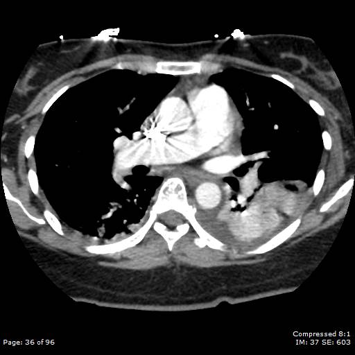 Bilateral pulmonary emboli with Hampton hump sign (Radiopaedia 54070-60246 Axial C+ CTPA 33).jpg