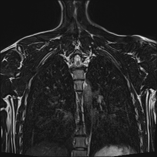 File:Bilateral spinoglenoid notch ganglion cysts (Radiopaedia 29577-30082 Coronal T2 96).jpg