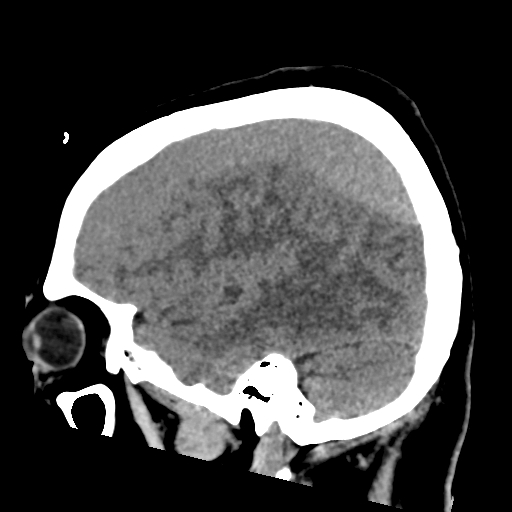 File:Bilateral subacute subdural hematoma (Radiopaedia 69240-79018 C 13).jpg