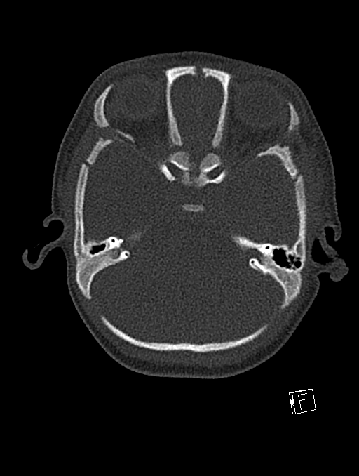 Bilateral subdural hemorrhage and parietal skull fracture (Radiopaedia 26058-26192 Axial bone window 100).png
