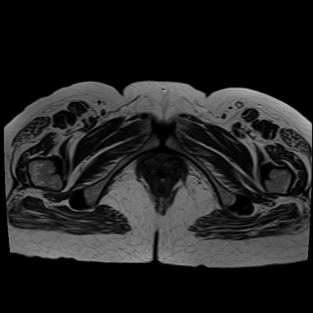Bilateral tubo-ovarian abscesses (Radiopaedia 58635-65829 Axial T2 46).jpg