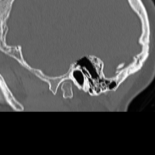 Bilateral tympanoplasty (Radiopaedia 16947-16664 Sagittal bone window 8).jpg