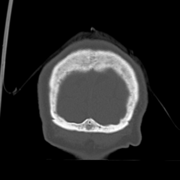 Biparietal osteodystrophy (Radiopaedia 46109-50463 Coronal bone window 99).jpg