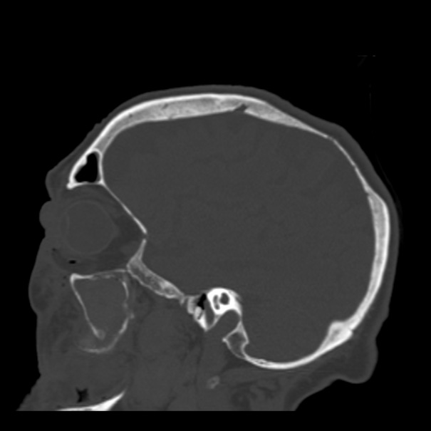 Biparietal osteodystrophy (Radiopaedia 46109-50463 Sagittal bone window 77).jpg