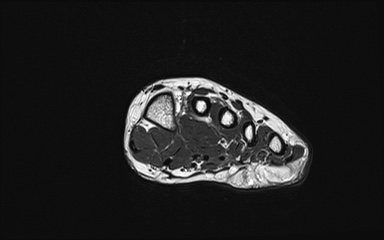 Bipartite hallux sesamoid diastasis (Radiopaedia 77133-89109 Coronal PD 14).jpg