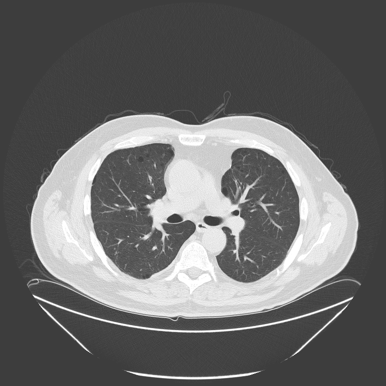 Birt-Hogg-Dubé syndrome (Radiopaedia 52578-58491 Axial lung window 27).jpg