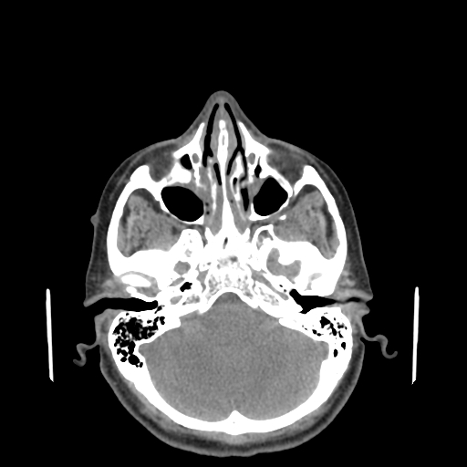 File:Bisphosphonate-related osteonecrosis of the jaw (Radiopaedia 71324-81642 non-contrast 158).jpg