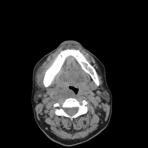 Bisphosphonate-related osteonecrosis of the jaw (Radiopaedia 71324-81642 non-contrast 52).jpg