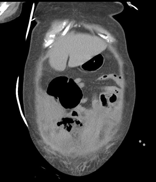 Bladder rupture post renal biopsy (Radiopaedia 30863-31572 Coronal non-contrast 13).jpg