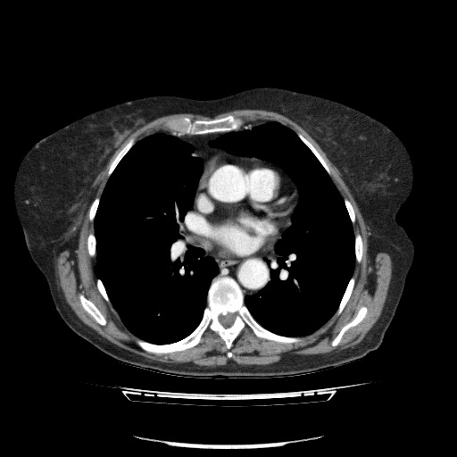 File:Bladder tumor detected on trauma CT (Radiopaedia 51809-57609 B 2).jpg