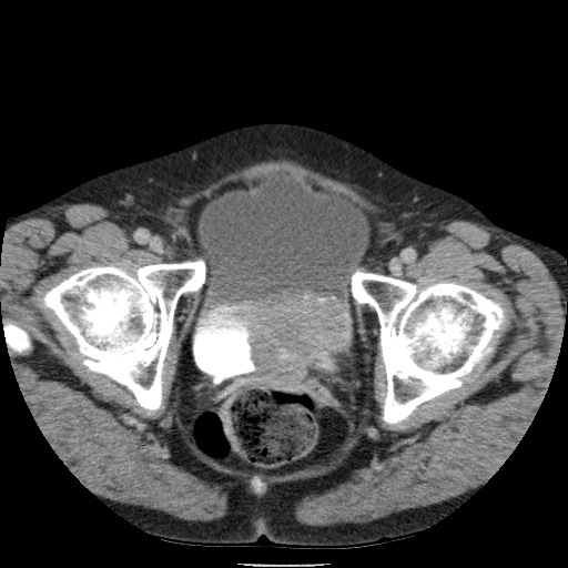 Bladder tumor detected on trauma CT (Radiopaedia 51809-57609 C 133).jpg