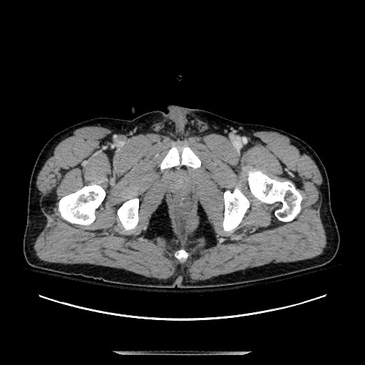 Blunt abdominal trauma with solid organ and musculoskelatal injury with active extravasation (Radiopaedia 68364-77895 A 159).jpg