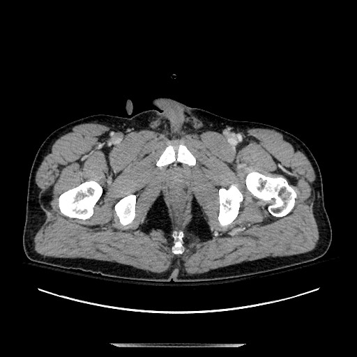Blunt abdominal trauma with solid organ and musculoskelatal injury with active extravasation (Radiopaedia 68364-77895 A 160).jpg