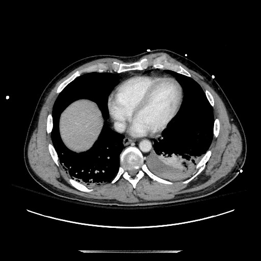 Blunt abdominal trauma with solid organ and musculoskelatal injury with active extravasation (Radiopaedia 68364-77895 A 5).jpg