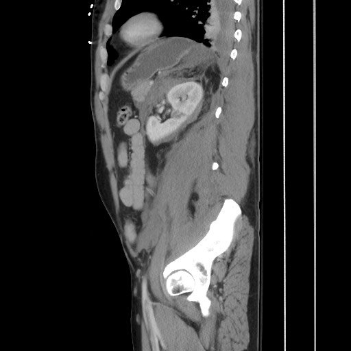 Blunt abdominal trauma with solid organ and musculoskelatal injury with active extravasation (Radiopaedia 68364-77895 C 103).jpg