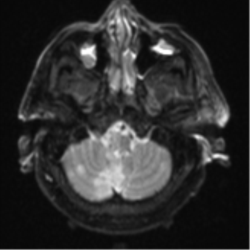 File:Blunt cerebrovascular injury (Radiopaedia 53682-59745 Axial DWI 6).png