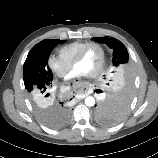 File:Boerhaave syndrome (Radiopaedia 39382-41661 A 35).png
