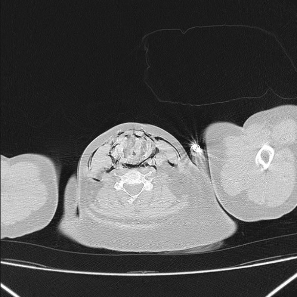 Boerhaave syndrome (Radiopaedia 45644-49799 Axial lung window 11).jpg