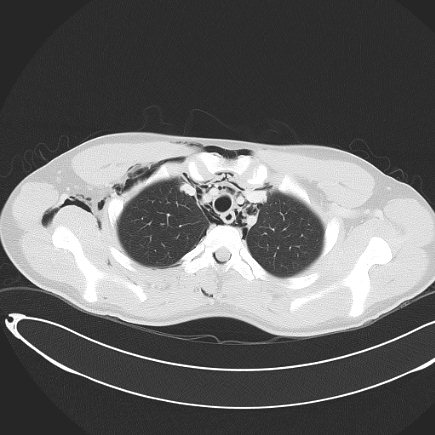 Boerhaave syndrome with mediastinal, axillary, neck and epidural free gas (Radiopaedia 41297-44115 Axial lung window 33).jpg