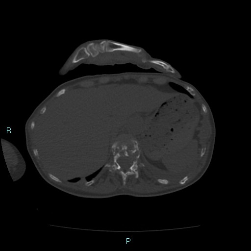 Bone metastases from untreated breast cancer (Radiopaedia 42973-46219 Axial bone window 89).jpg