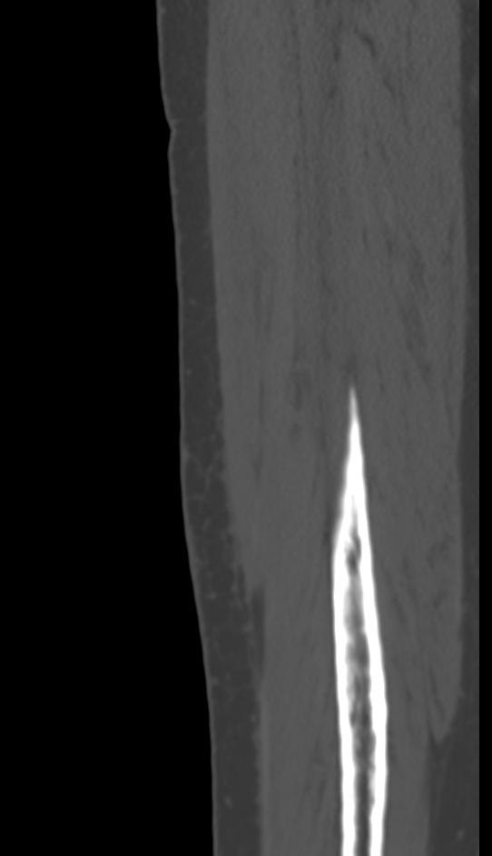 Bone metastasis - tibia (Radiopaedia 57665-64609 Sagittal bone window 150).jpg