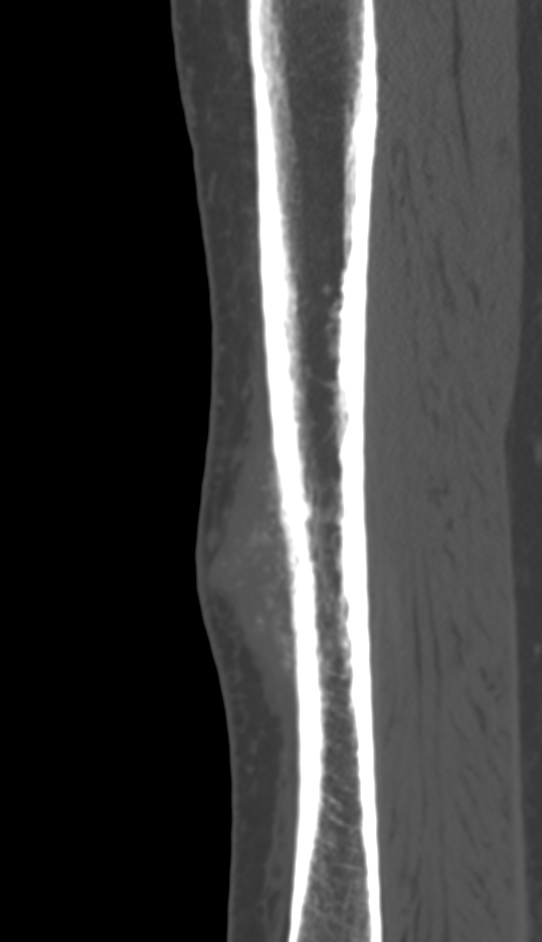 Bone metastasis - tibia (Radiopaedia 57665-64609 Sagittal bone window 66).jpg