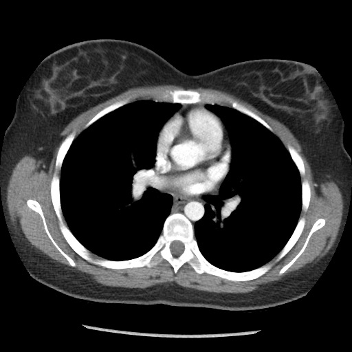 File:Borderline mucinous tumor (ovary) (Radiopaedia 78228-90808 A 23).jpg