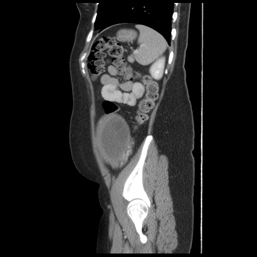 File:Borderline mucinous tumor (ovary) (Radiopaedia 78228-90808 B 52).jpg