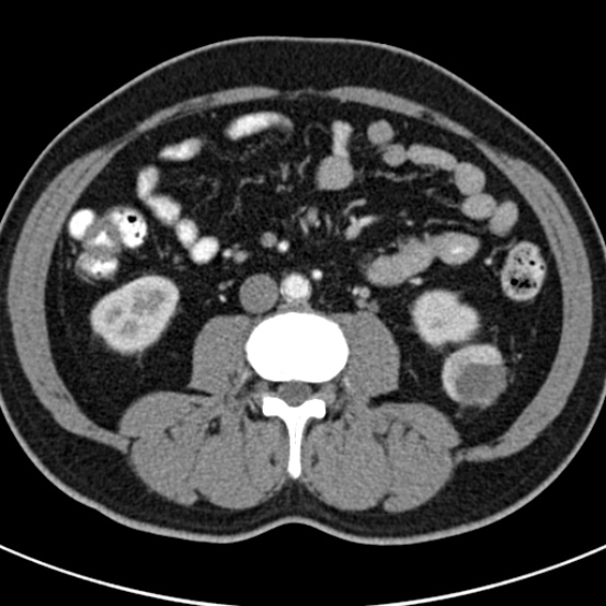 File:Bosniak cyst - type IV (Radiopaedia 23525-23627 renal cortical phase 41).jpg