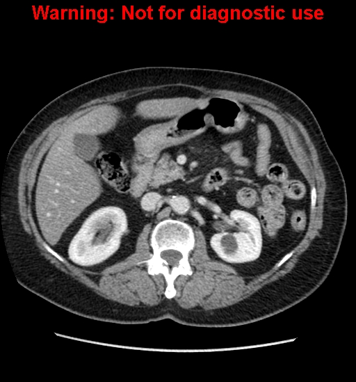 File:Bosniak renal cyst - type II (Radiopaedia 23404-23468 D 27).jpg