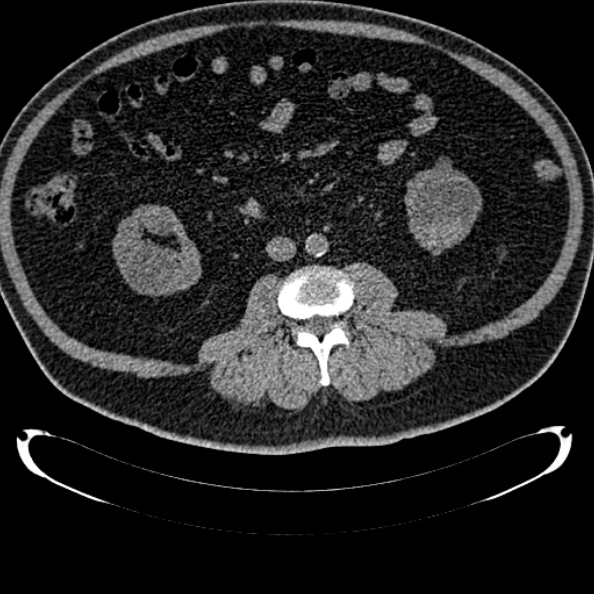 Bosniak renal cyst - type IV (Radiopaedia 24244-24518 Axial non-contrast 169).jpg