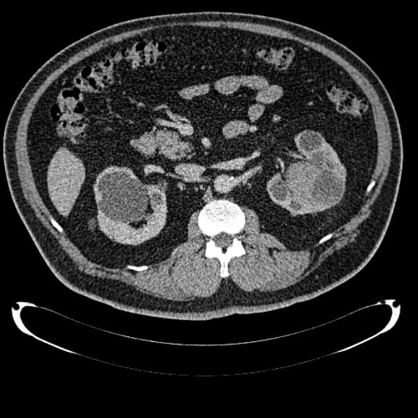 File:Bosniak renal cyst - type IV (Radiopaedia 24244-24518 C 140).jpg