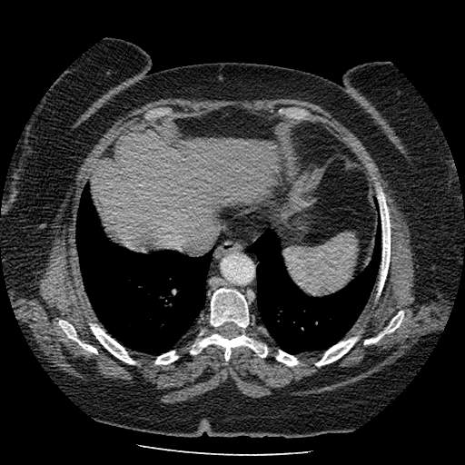 Bovine aortic arch - right internal mammary vein drains into the superior vena cava (Radiopaedia 63296-71875 A 123).jpg